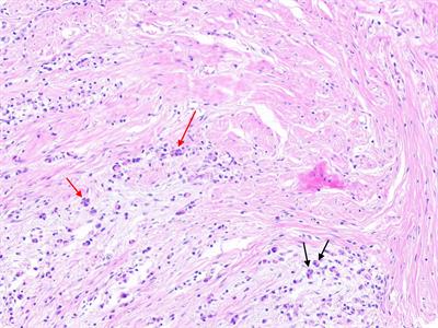 Tumor budding as a predictor for prognosis and therapeutic response in gastric cancer: A mini review